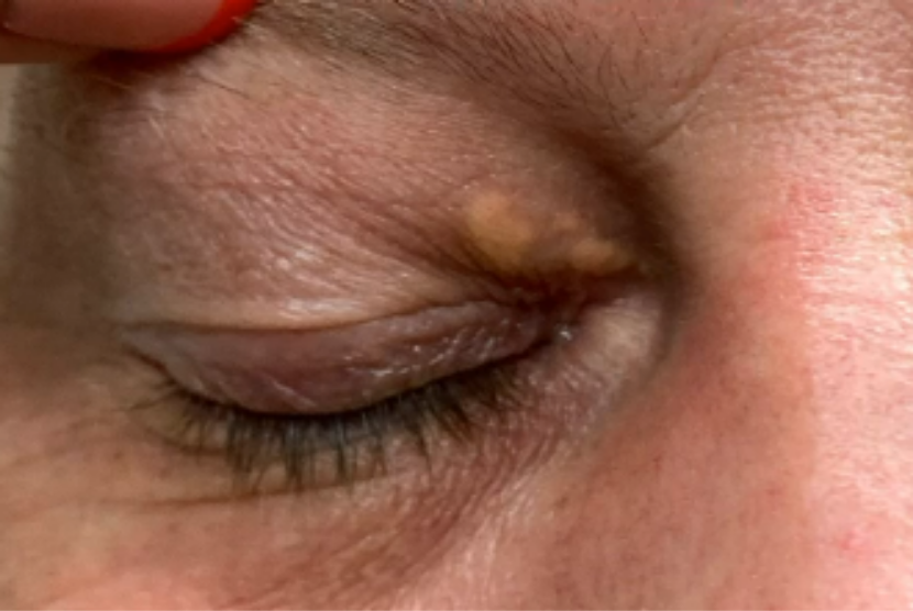 Xanthelasma Sering Terlihat pada Stadium Lanjut Penyakit Hati Berlemak